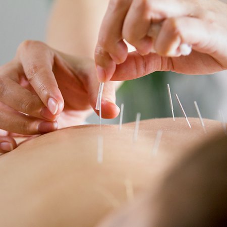 Acupuncturist